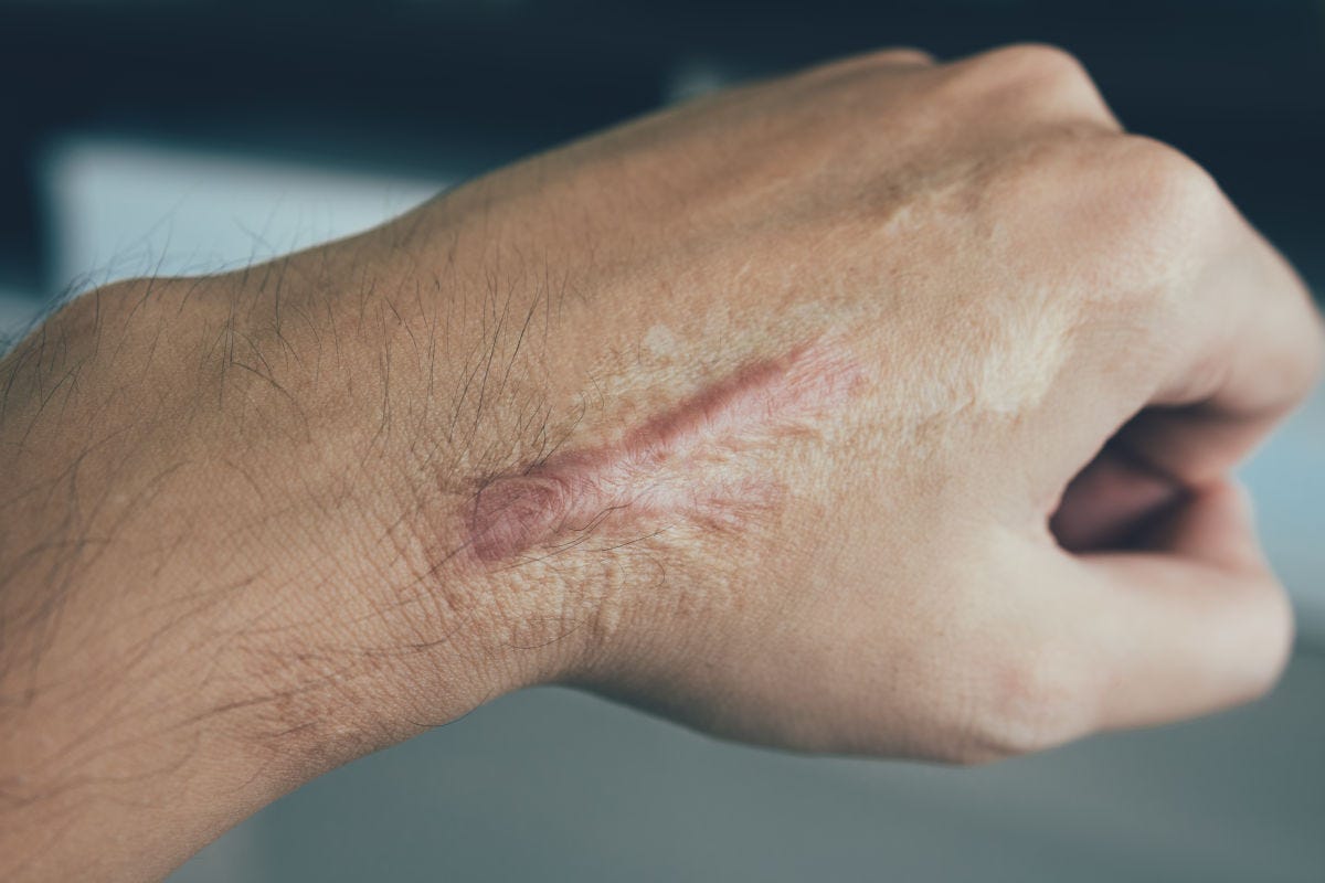 Cicatrice cheloide, a cosa servono le infiltrazioni? Un trattamento ben tollerato, efficace e senza dolore