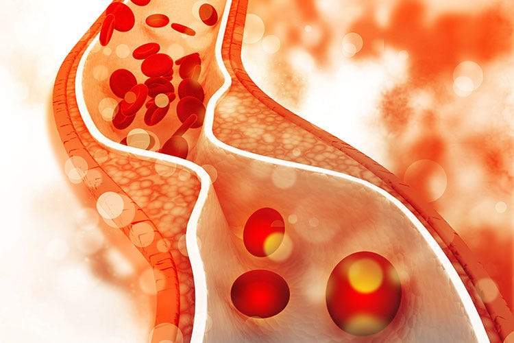 Un livello eccessivo di LDL può provocare placche arteriosclerotiche - Sport, frutta secca e pesci grassi per vincere il colesterolo cattivo