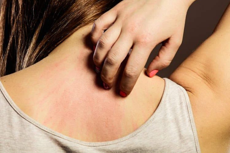 Lo stress può essere la causa dell'insorgenza di dermatiti - Stress da isolamento forzato Attenzione, può causare dermatiti