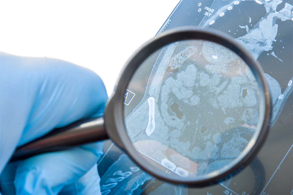 Una ricerca ha dimostrato delle correlazioni tra intolleranza al glutine e quantit&agrave; di sostanza bianca cerebrale