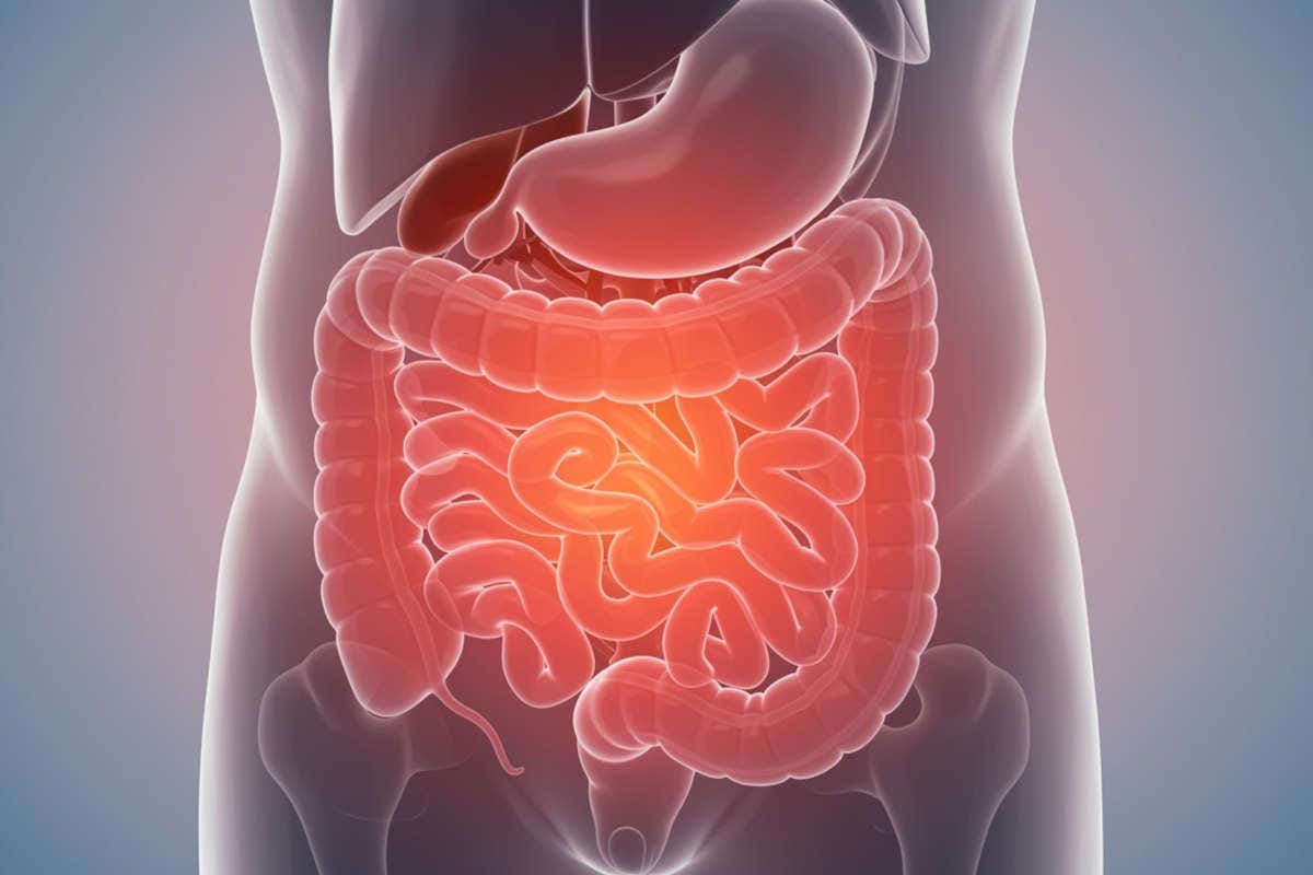 Polipi intestinali e tumore del colon: tutto ciò che devi sapere Polipi intestinali e tumore del colon: tutto ciò che devi sapere