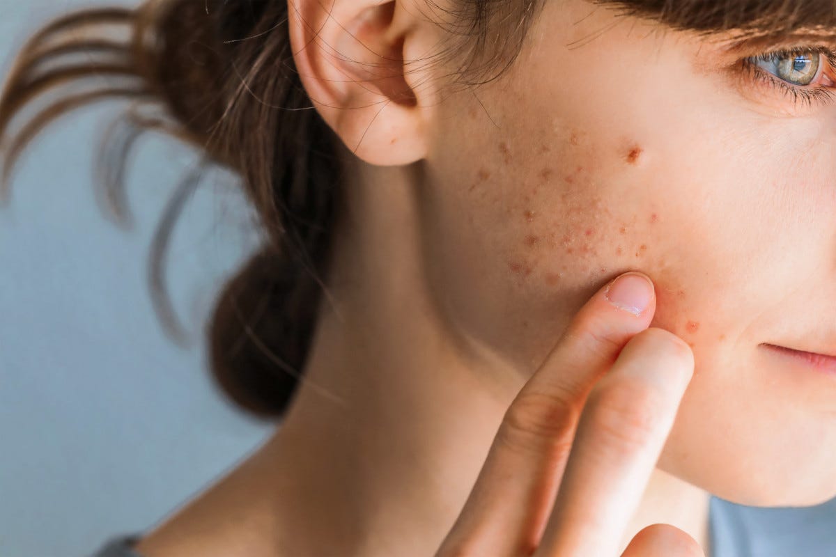 Bardana e tarassaco contro l’acne: ecco come preparare la tisana anti brufoli