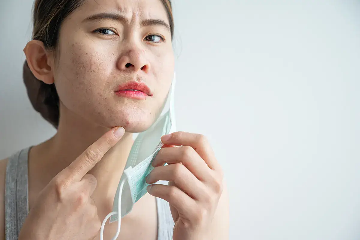Mascherina, che problema! La mascherina favorisce l'acne. Per combatterla, serve una sana alimentazione
