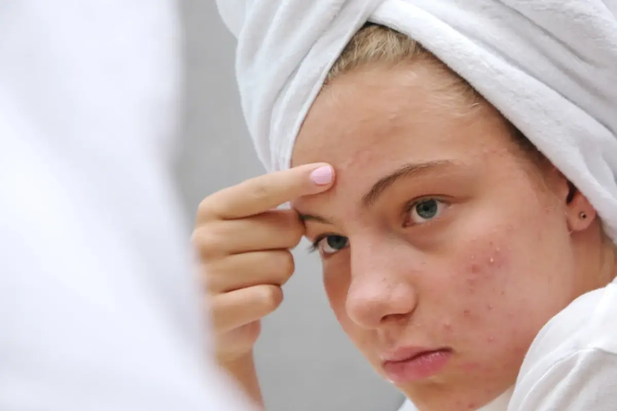 Il laser contro le cicatrici da acne