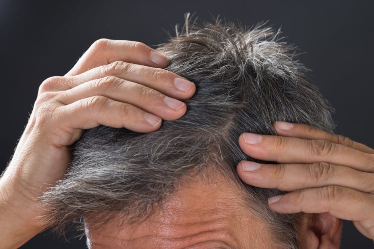 Le cause della caduta dei capelli sono molteplici (Caduta dei capelli, per curarlaservono farmaci e bisturi)
