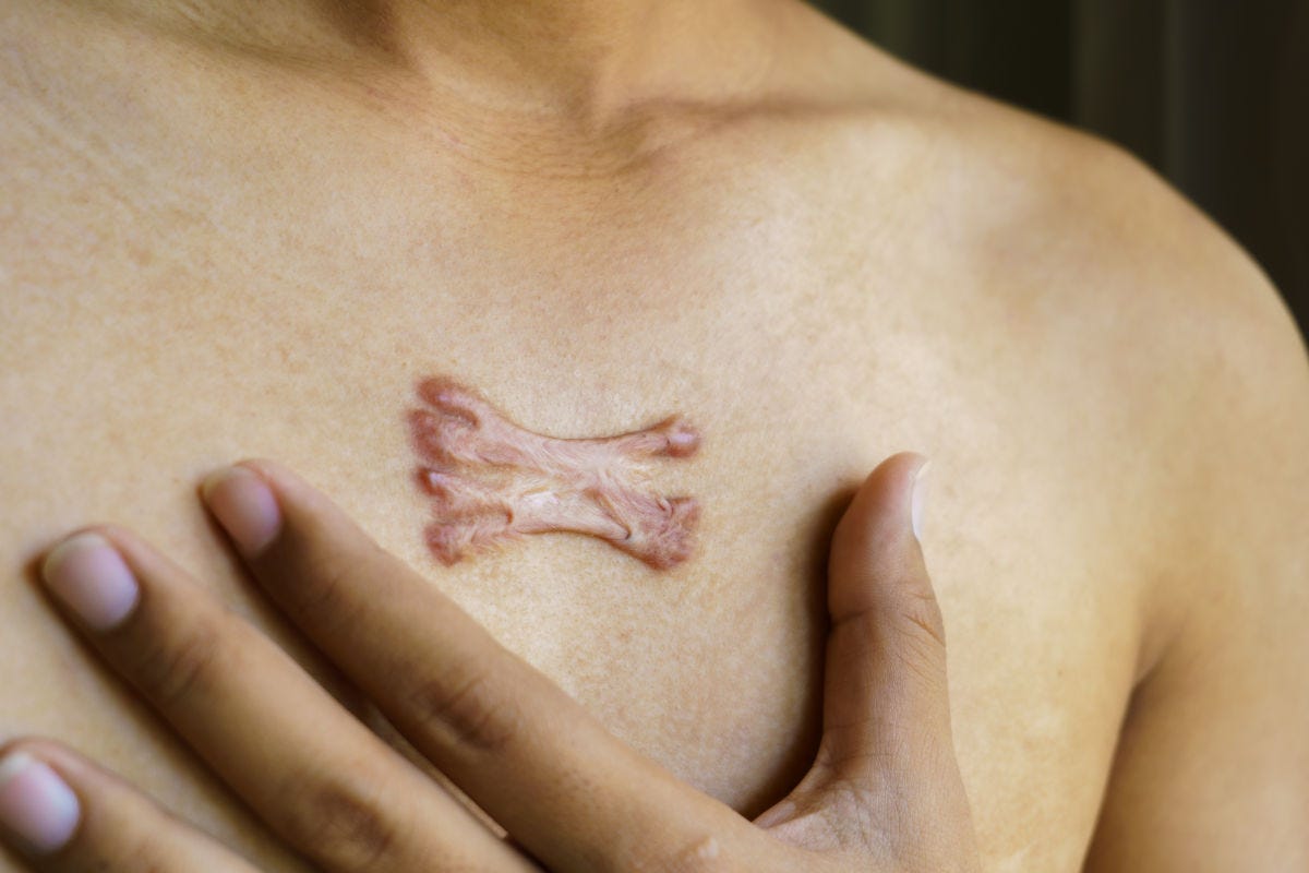 Cicatrice cheloide, a cosa servono le infiltrazioni? Un trattamento ben tollerato, efficace e senza dolore