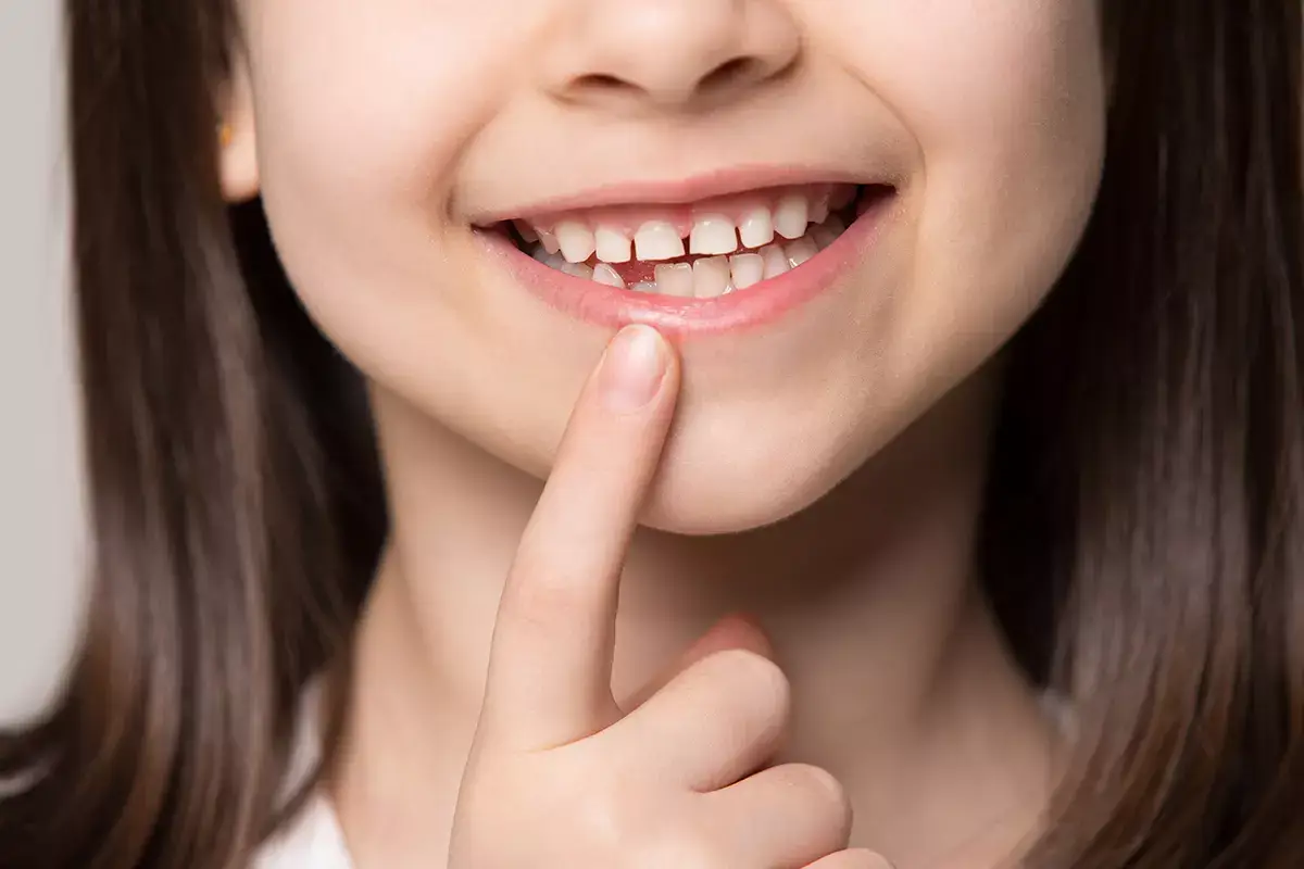 Sigillatura dei denti: ecco quando serve farla