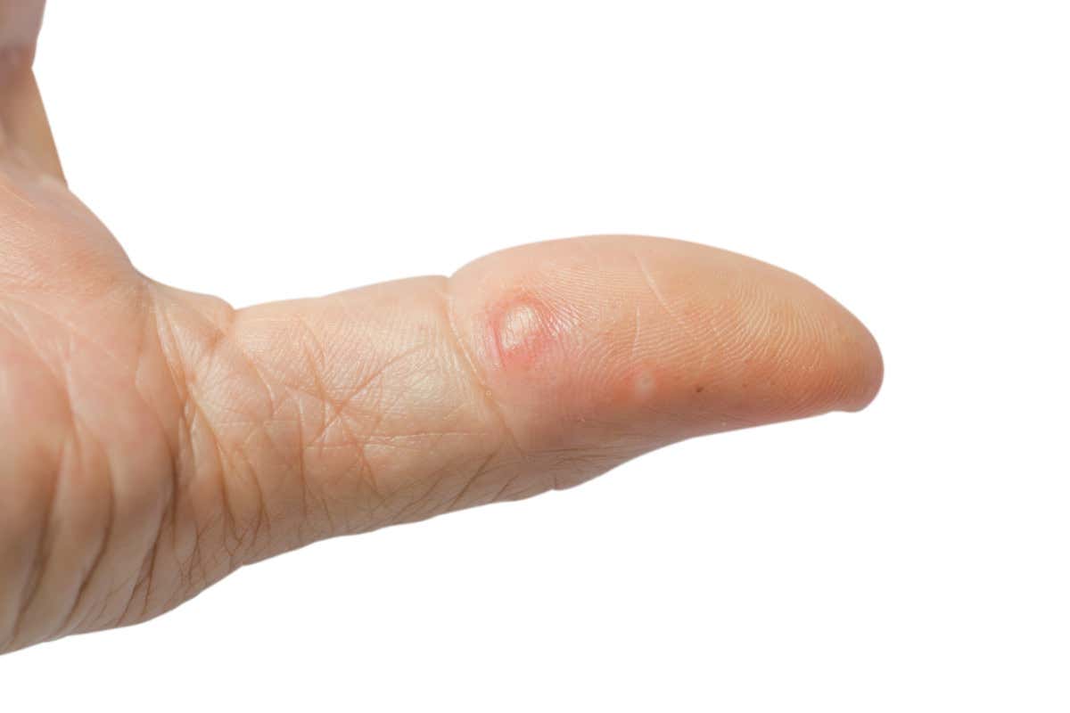 Bollicine su mani e piedi: cos'è la disidrosi?