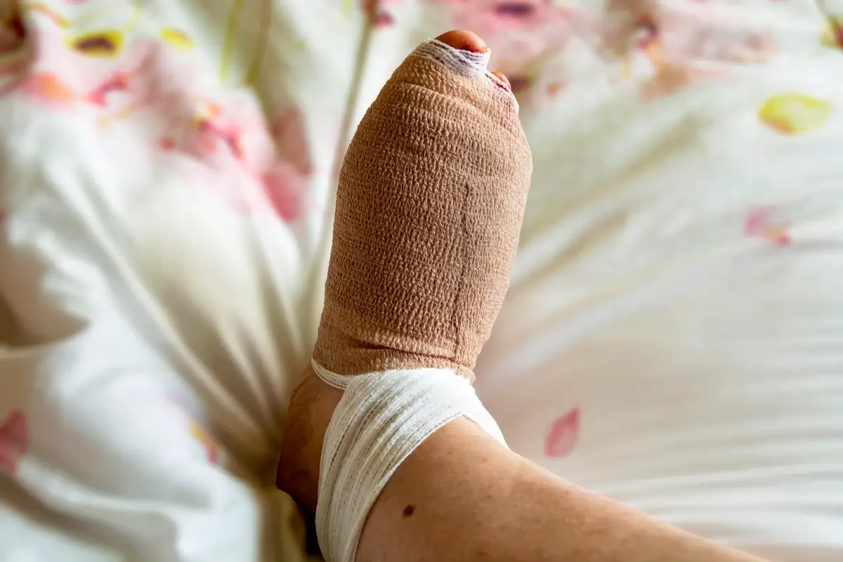 Dita a martello, cosa sono e come si curano