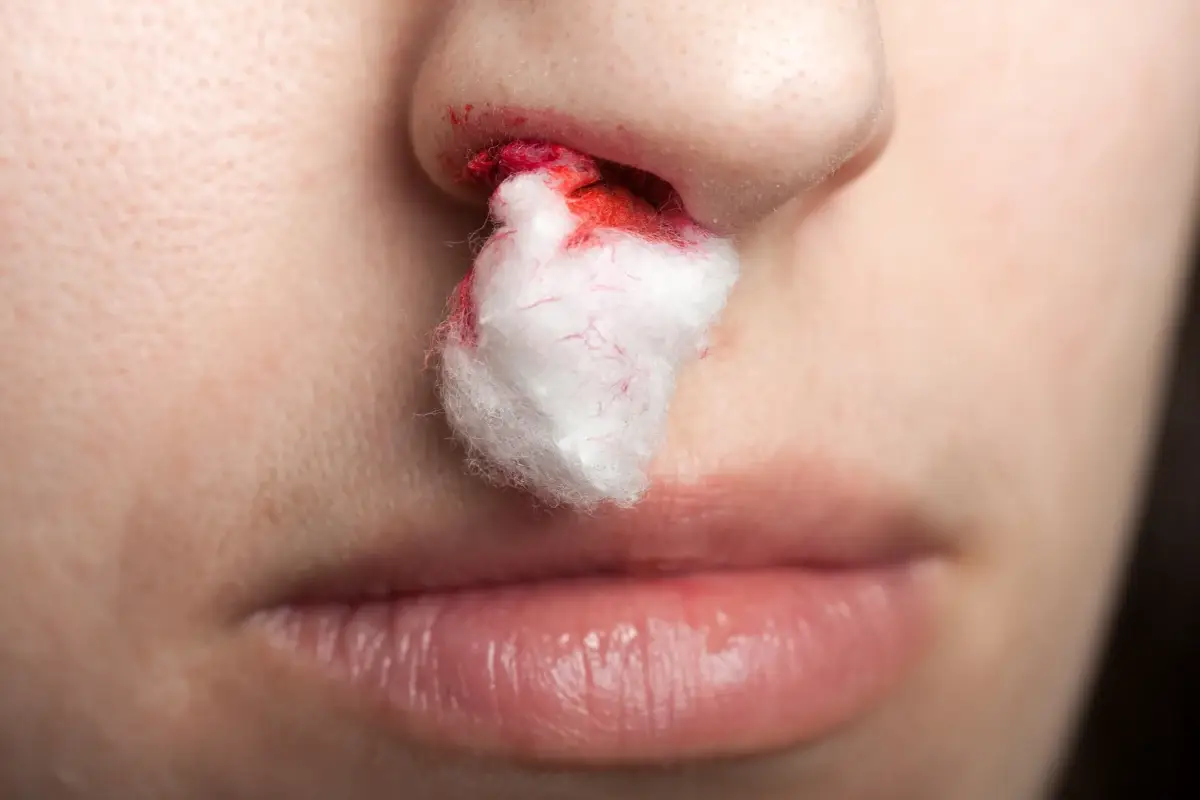 Epistassi: come comportarsi quando si perde sangue dal naso?