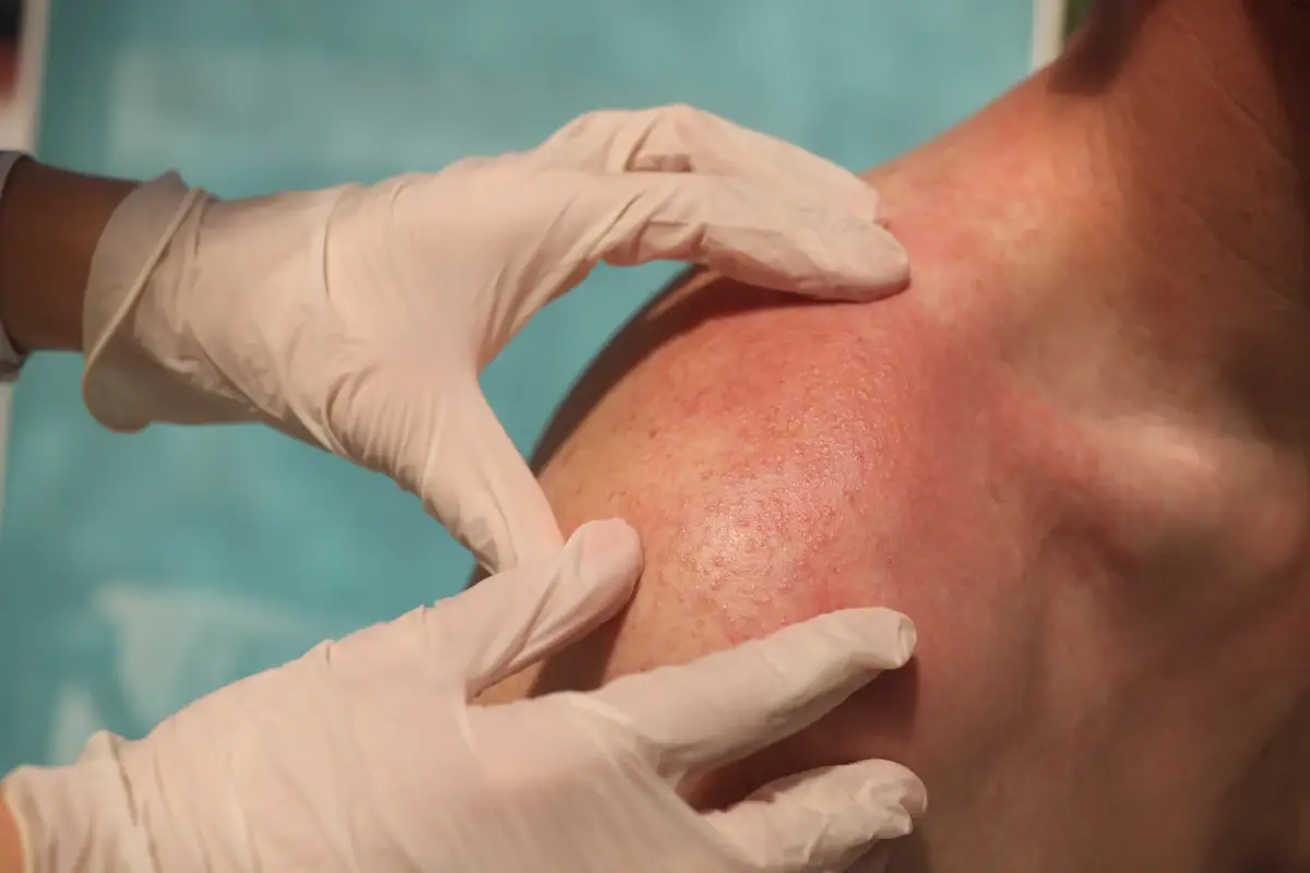 Eritema solare: come prevenirlo e come&nbsp;curarlo