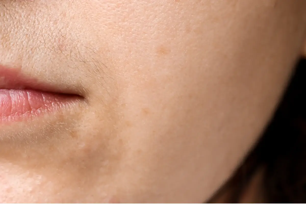 Donne e aumento della peluria: come si cura l&rsquo;irsutismo?