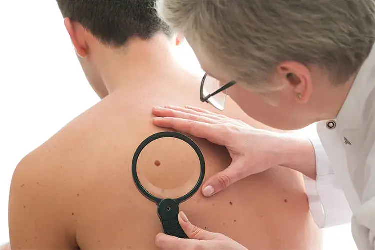 Visite a cadenza regolare dal dermatologo per la mappatura dei nei: la miglior prevenzione al melanoma