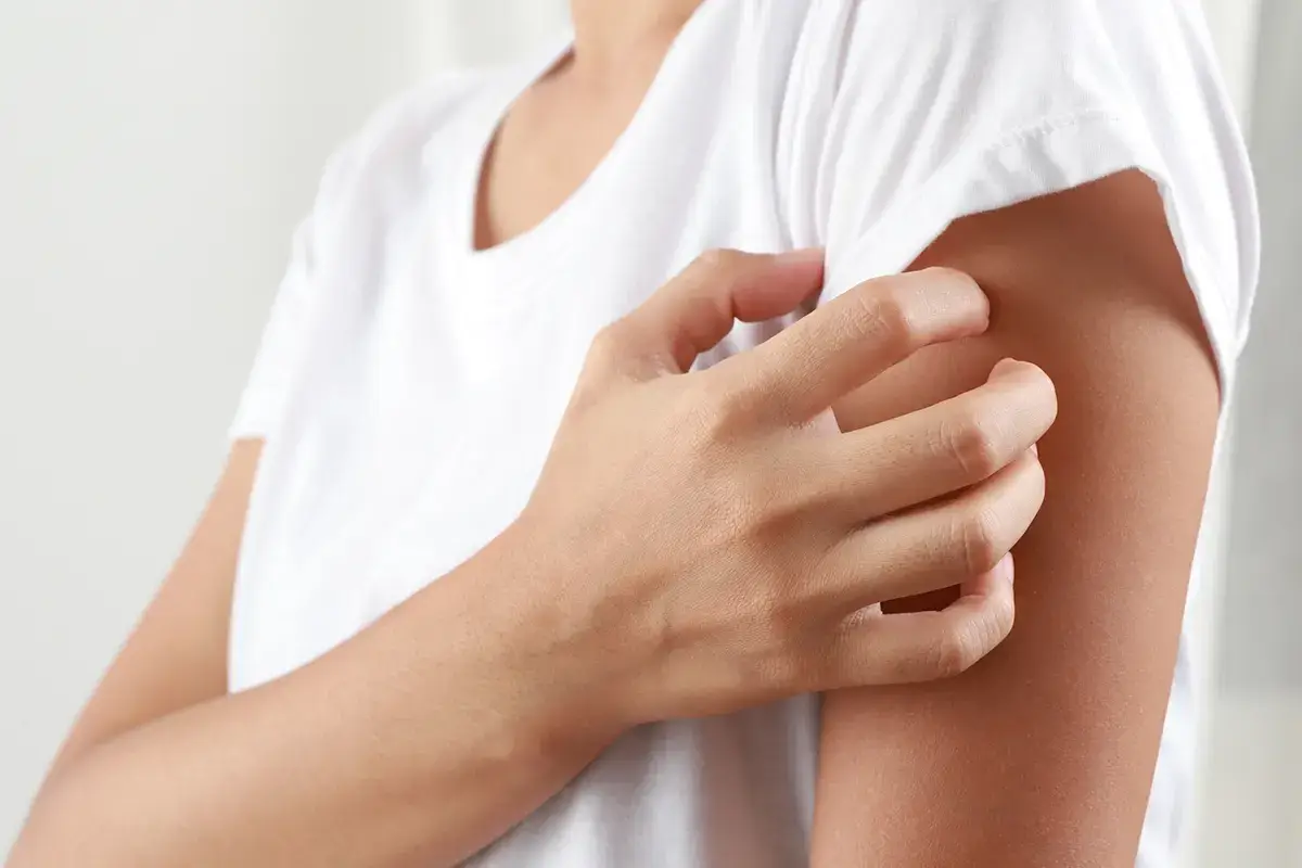 Quali sono i sintomi dell'orticaria? Orticaria, quali sono i sintomi e come si cura