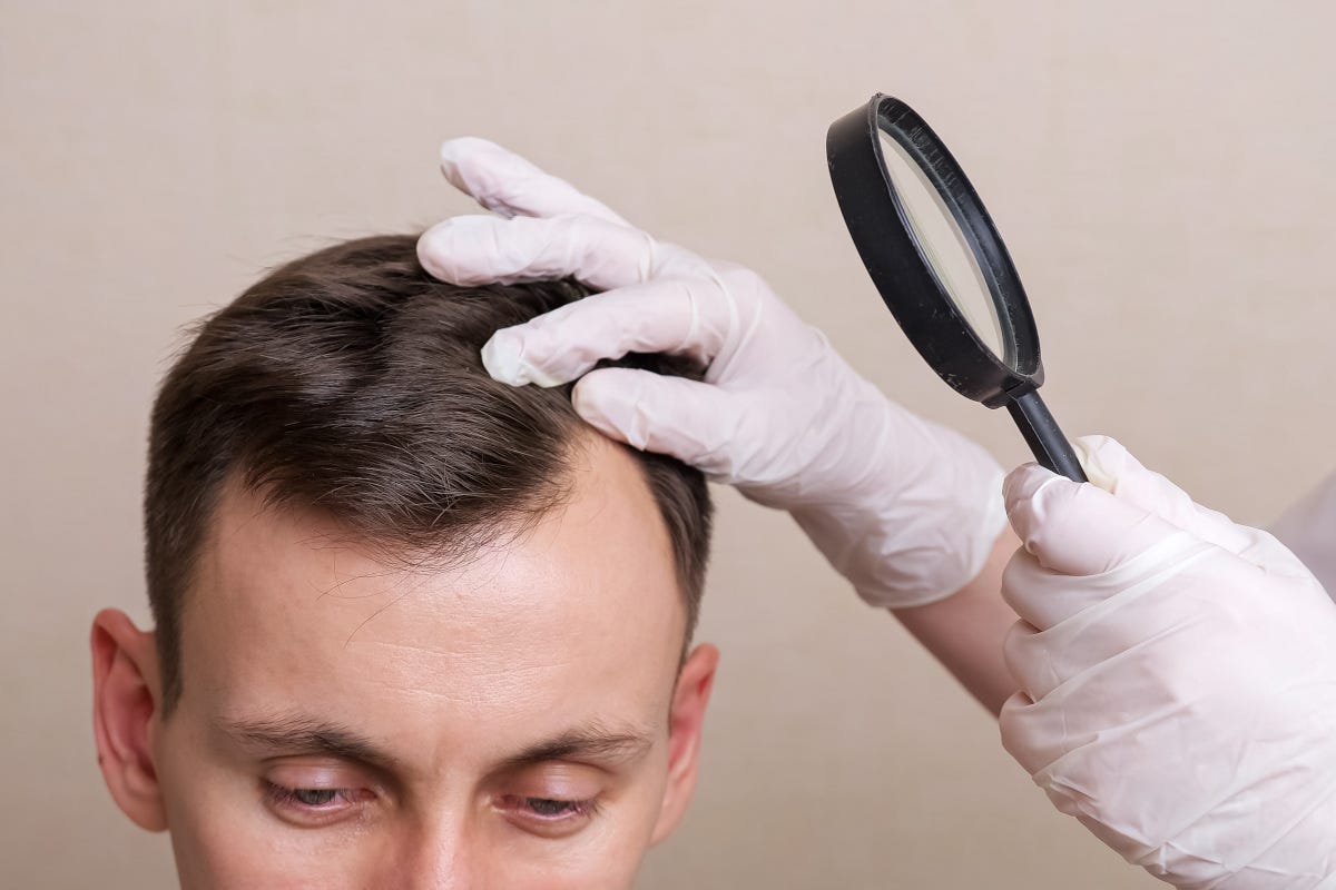 Caduta dei capelli negli uomini: perché succede?