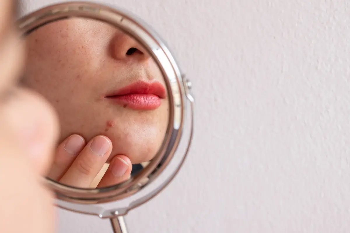 Il laser contro le cicatrici da acne
