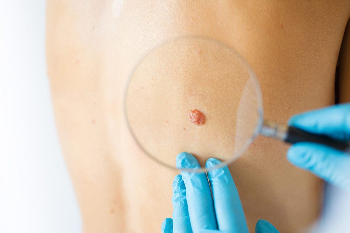 Esistono diversi tipi di tumore alla pelle, alcuni meno pericolosi, altri più invasivi