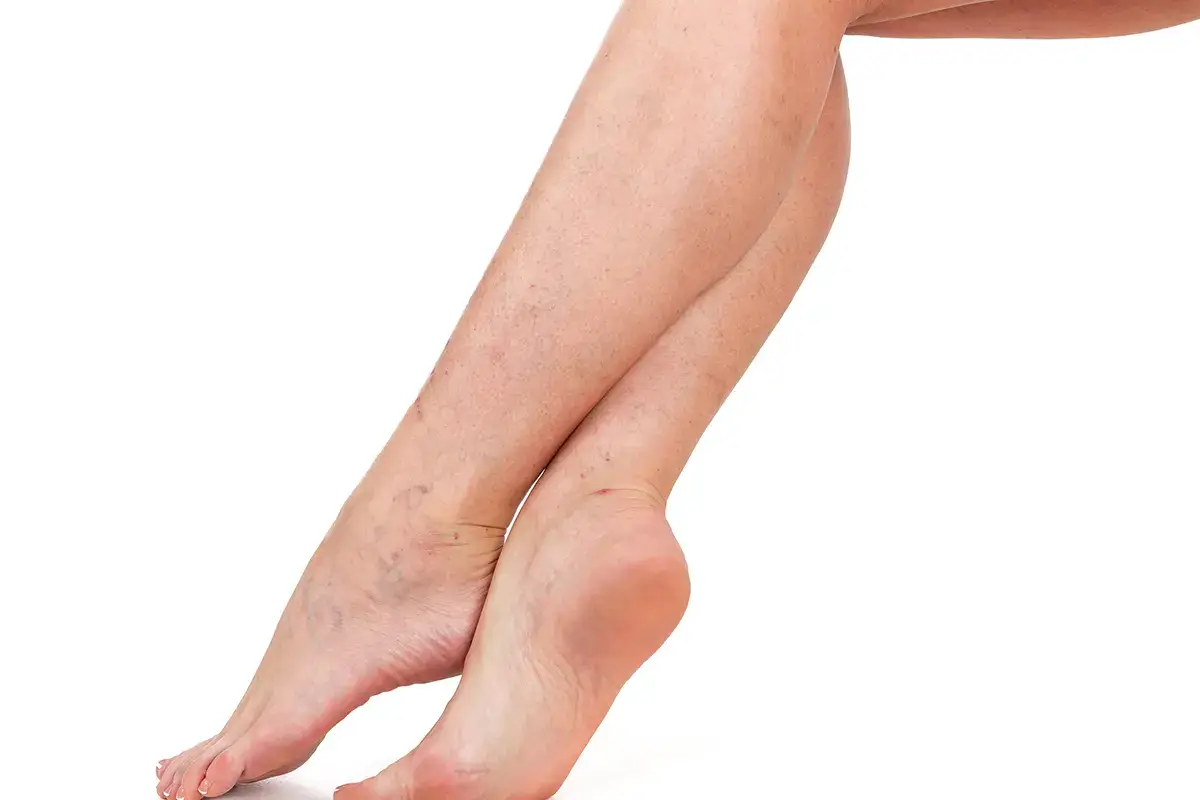 Vene varicose: quali rimedi? Vene varicose, cosa sono e come prevenirle
