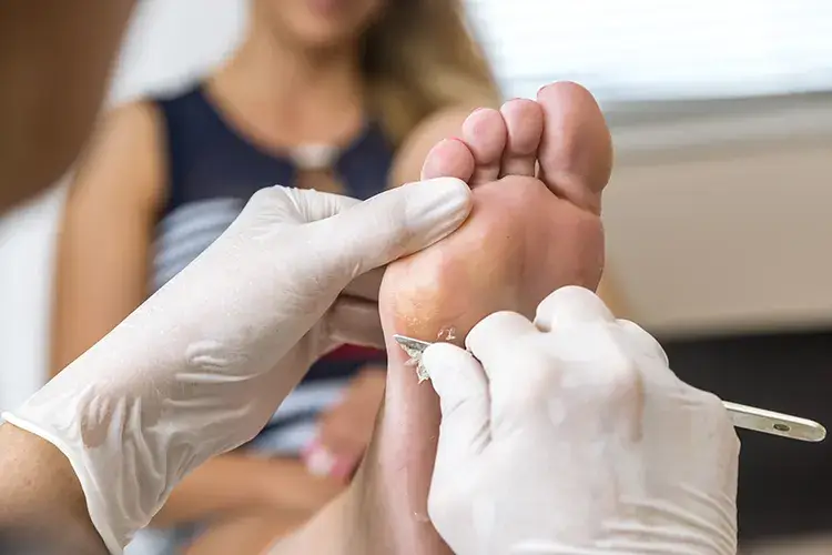 Verruche, facilmente trasmissibili e dolorose